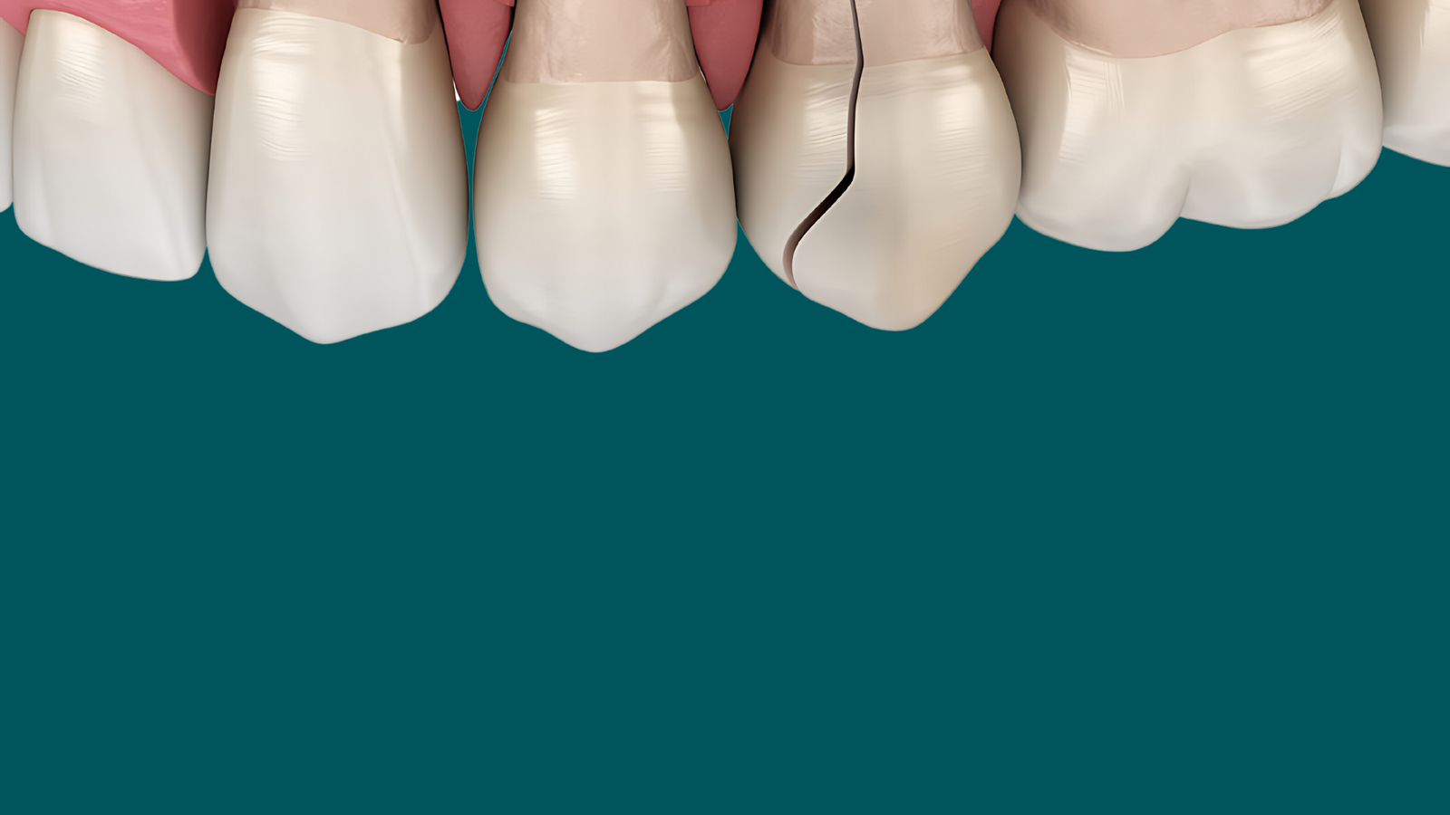 Trauma & Tooth Fracture