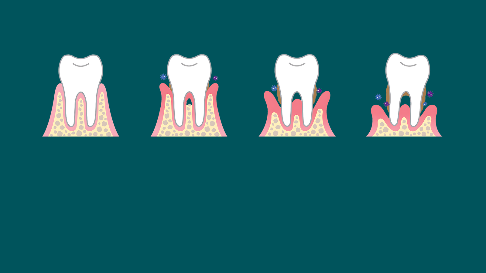 Periodontal Disease